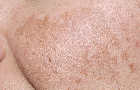 Közeli kép egy a Melasma tüneteit produkáló női arcról