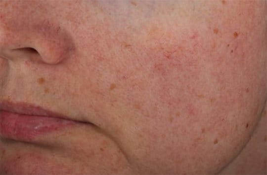 Az Eucerin® Anti-Redness Bőrpír elleni arcápoló termék hatékonyságáról az In Vivo tanulmány során készült fotók
