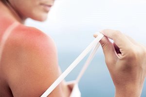 Így kezeljük az égéseket