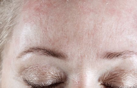 Egy nő hámló homloka